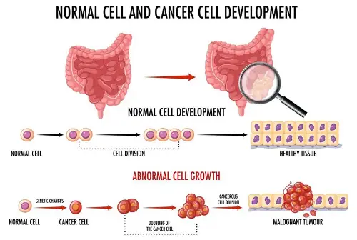 Colon cancer begins with abnormal proliferation of cells.